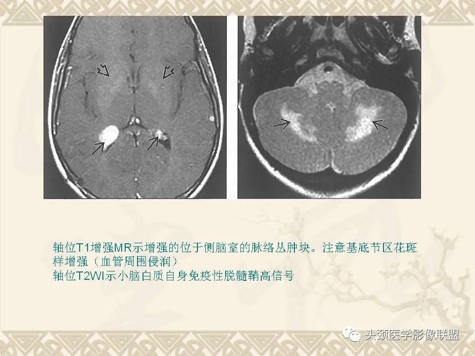 【PPT】颅骨肿瘤的影像学诊断与鉴别诊断-43