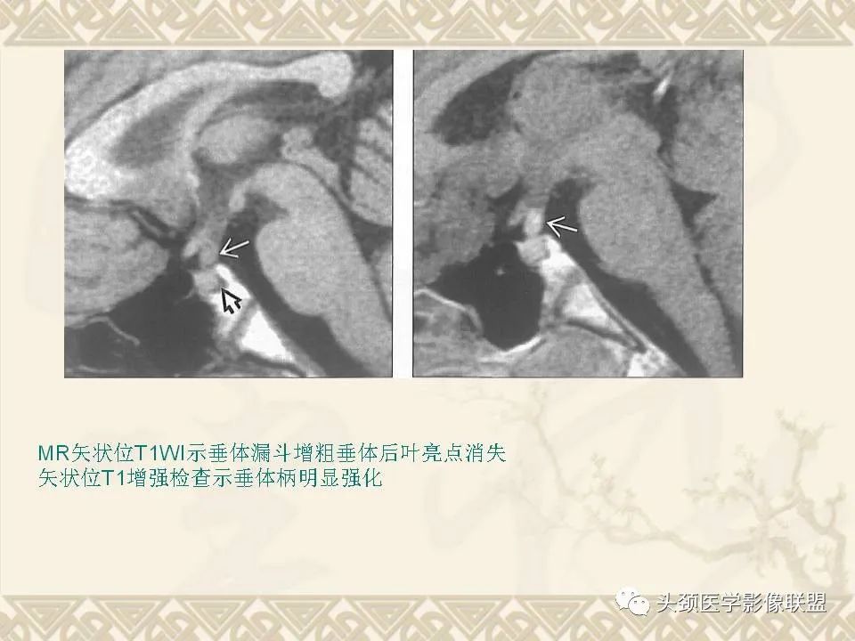 【PPT】颅骨肿瘤的影像学诊断与鉴别诊断-44