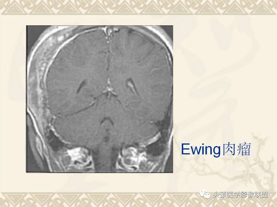 【PPT】颅骨肿瘤的影像学诊断与鉴别诊断-46