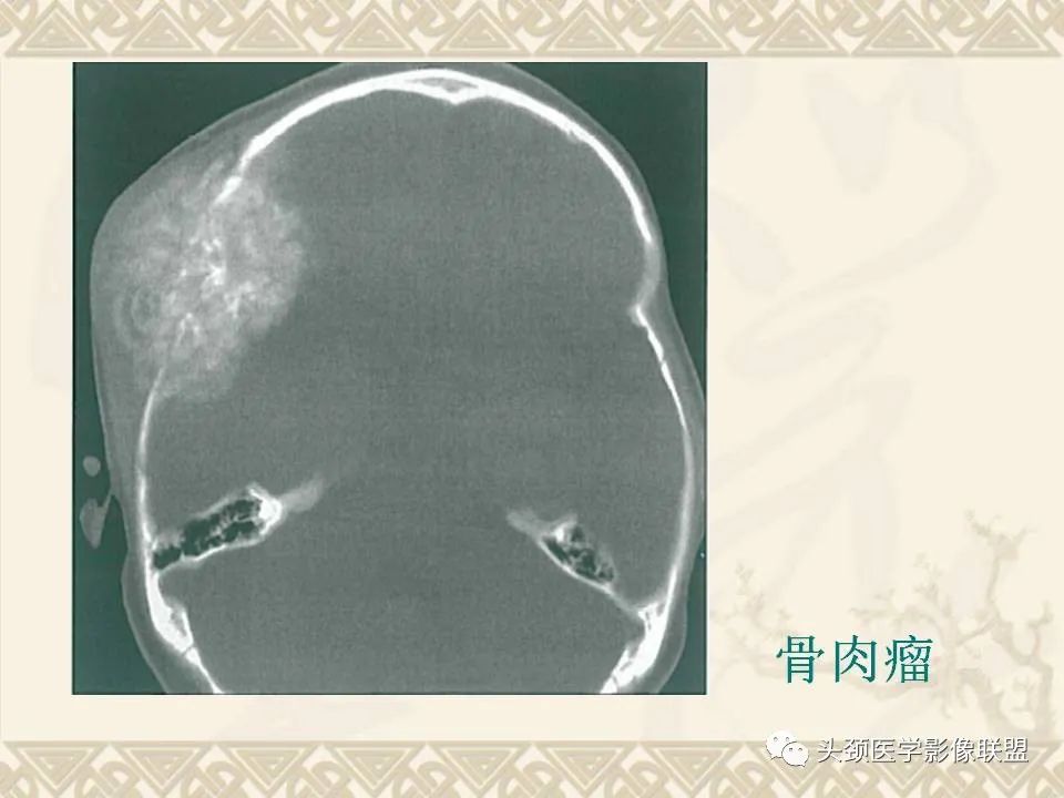 【PPT】颅骨肿瘤的影像学诊断与鉴别诊断-48