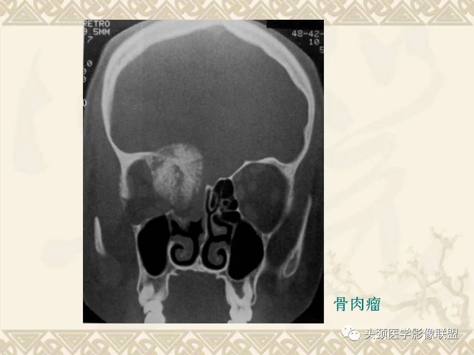 【PPT】颅骨肿瘤的影像学诊断与鉴别诊断-49