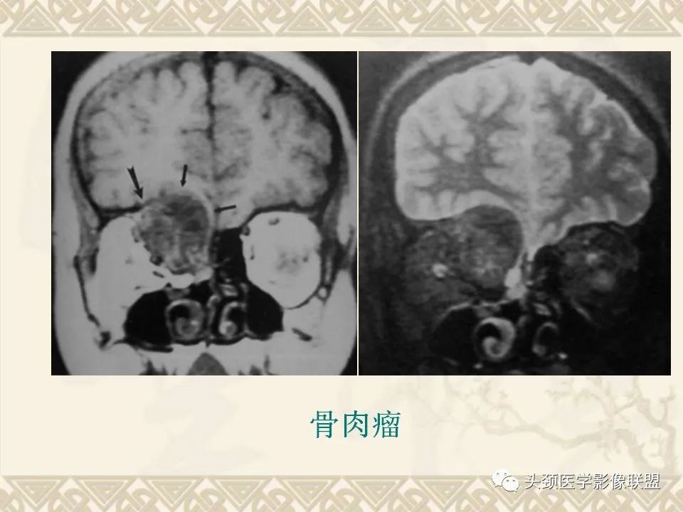 【PPT】颅骨肿瘤的影像学诊断与鉴别诊断-50