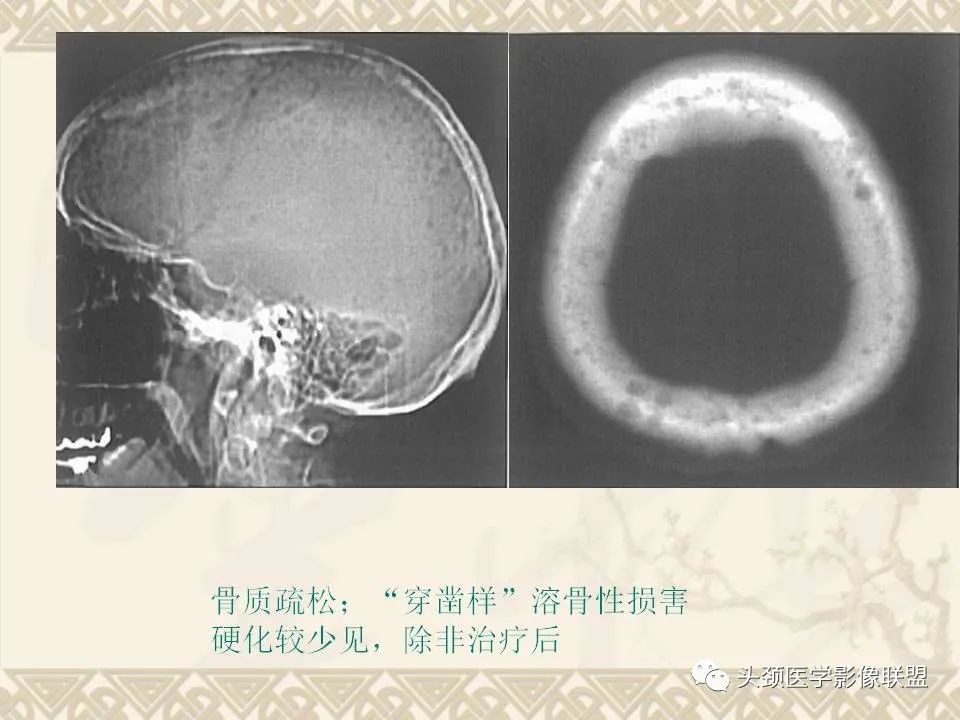 【PPT】颅骨肿瘤的影像学诊断与鉴别诊断-52