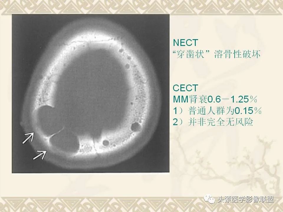 【PPT】颅骨肿瘤的影像学诊断与鉴别诊断-53