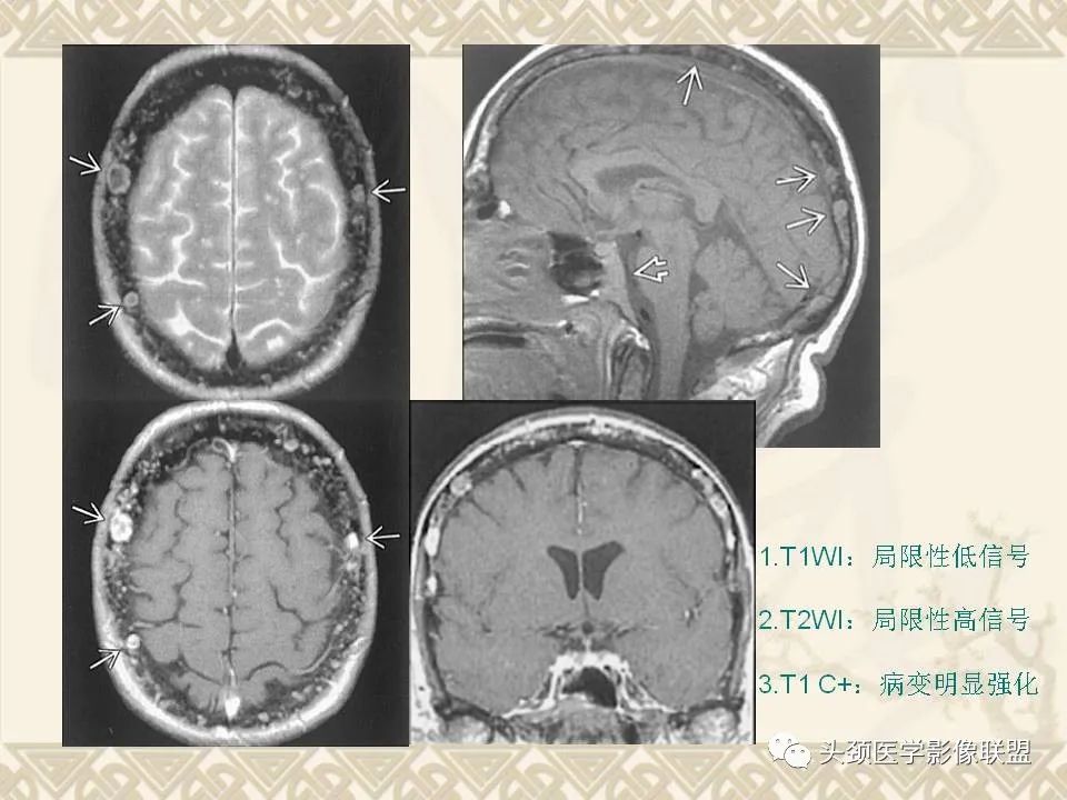 【PPT】颅骨肿瘤的影像学诊断与鉴别诊断-54