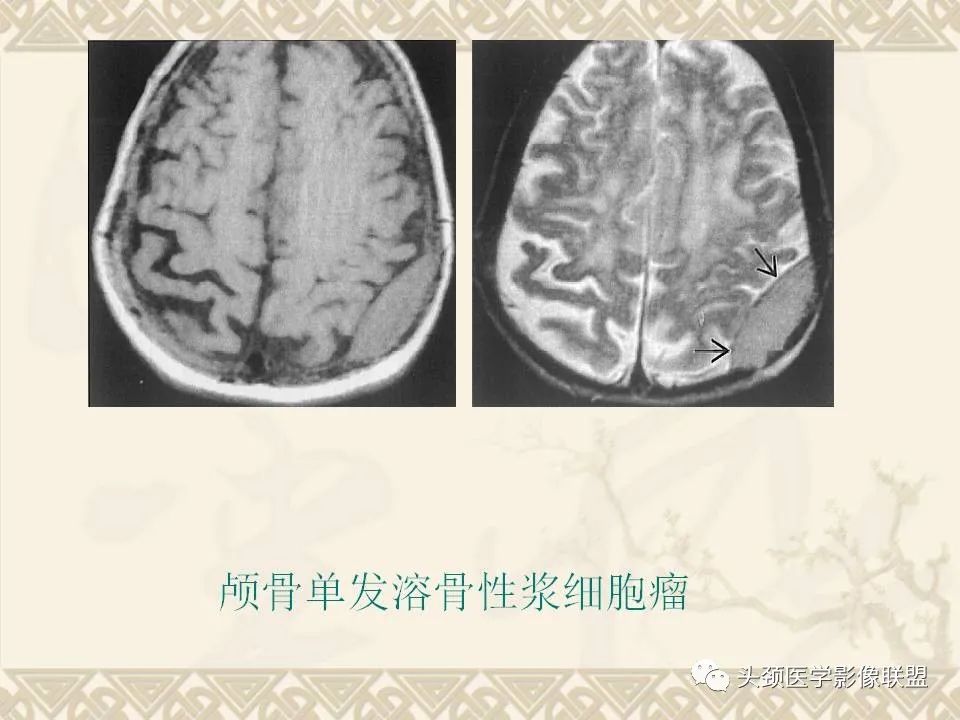 【PPT】颅骨肿瘤的影像学诊断与鉴别诊断-55