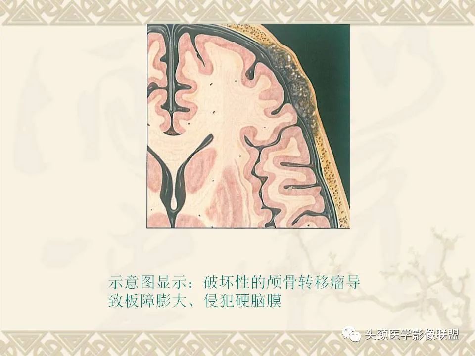 【PPT】颅骨肿瘤的影像学诊断与鉴别诊断-57