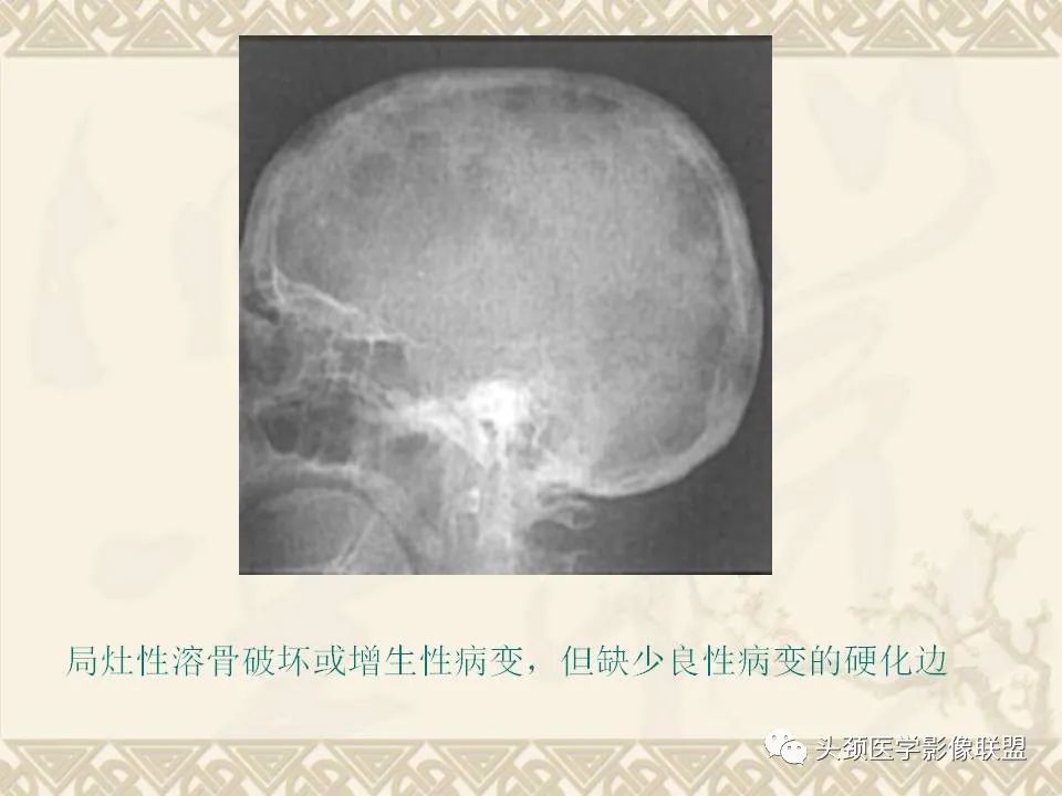 【PPT】颅骨肿瘤的影像学诊断与鉴别诊断-58