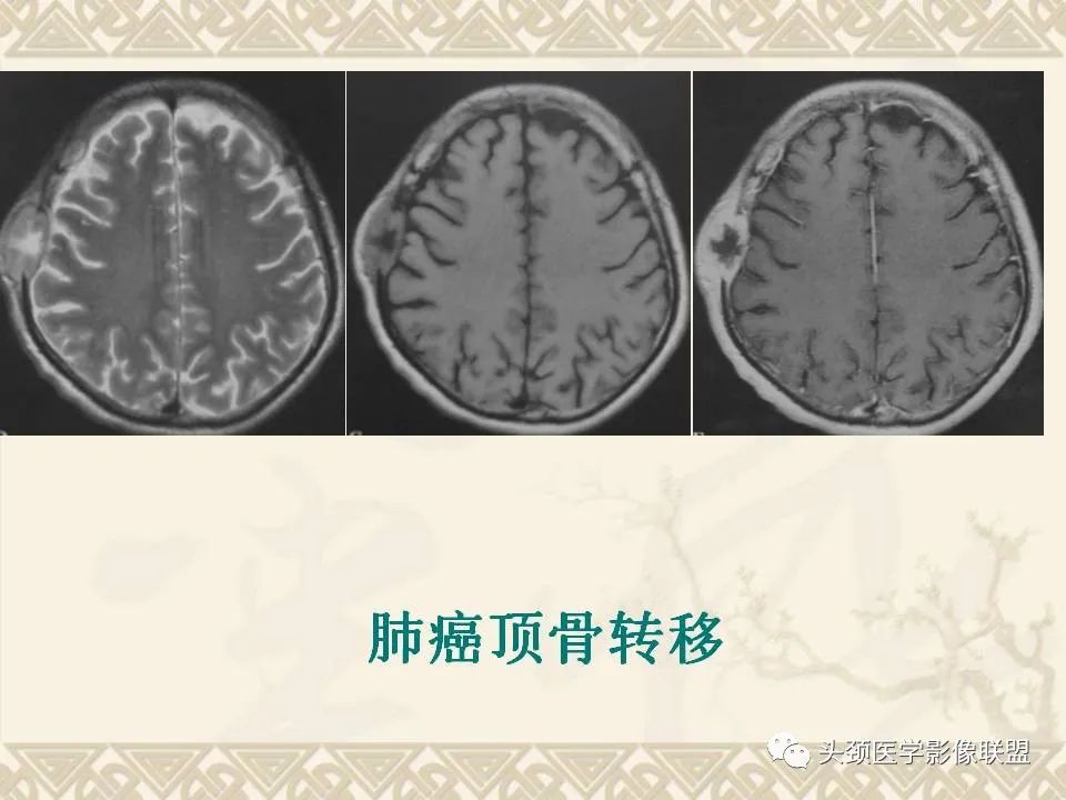 【PPT】颅骨肿瘤的影像学诊断与鉴别诊断-60