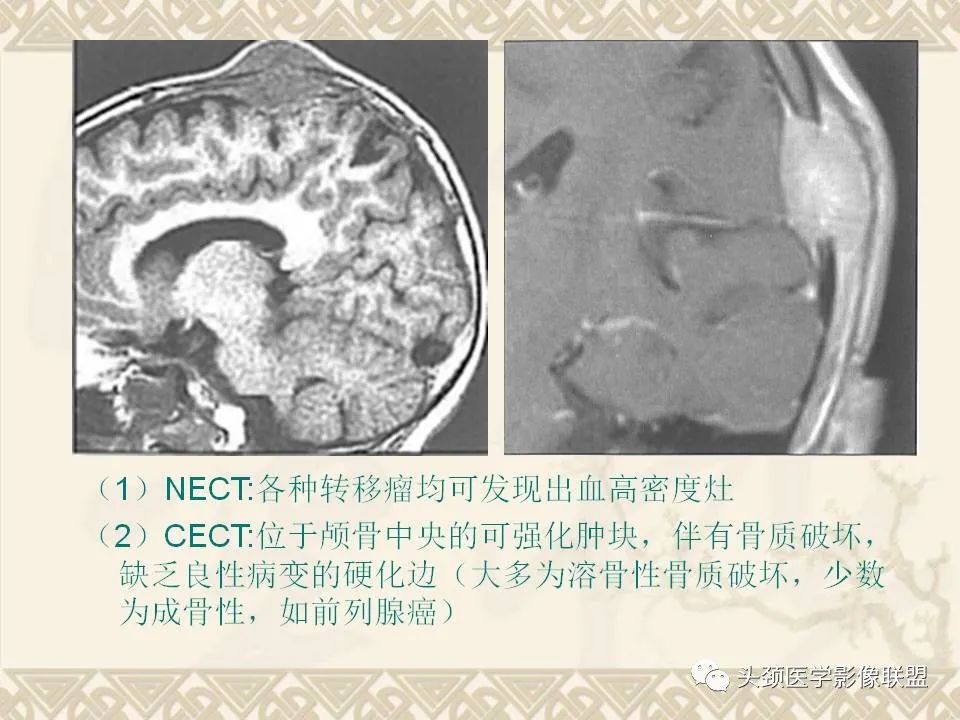 【PPT】颅骨肿瘤的影像学诊断与鉴别诊断-61