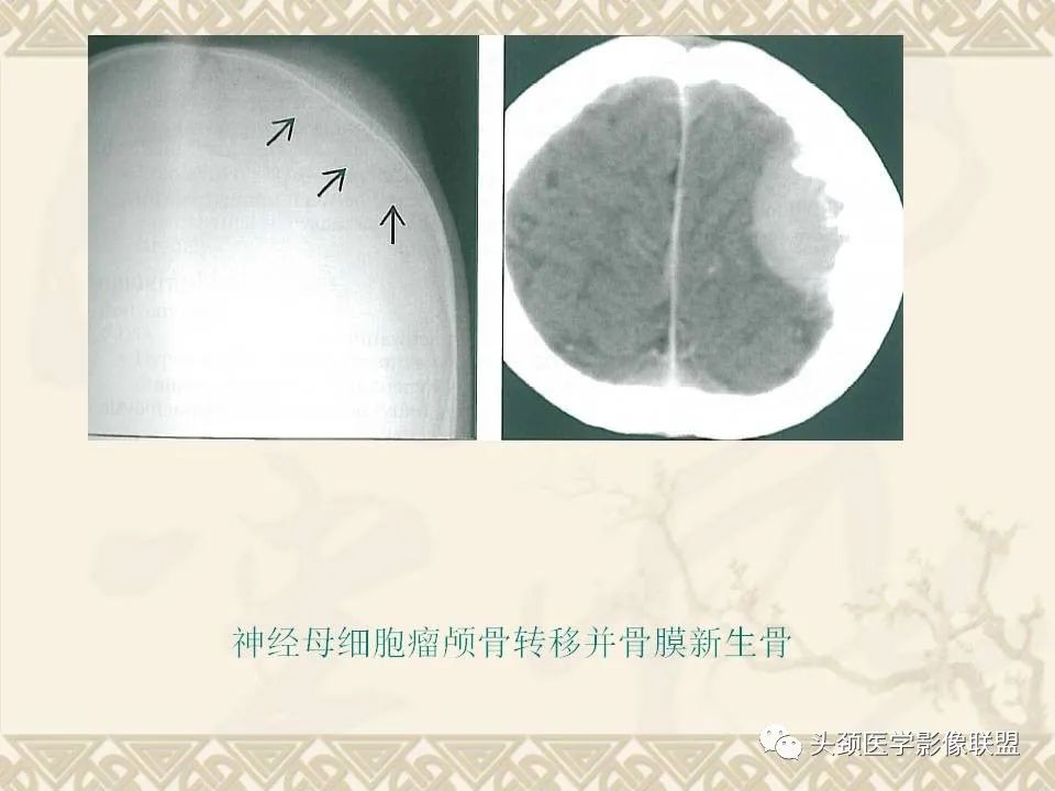 【PPT】颅骨肿瘤的影像学诊断与鉴别诊断-62