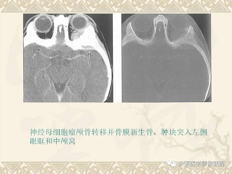 【PPT】颅骨肿瘤的影像学诊断与鉴别诊断-63