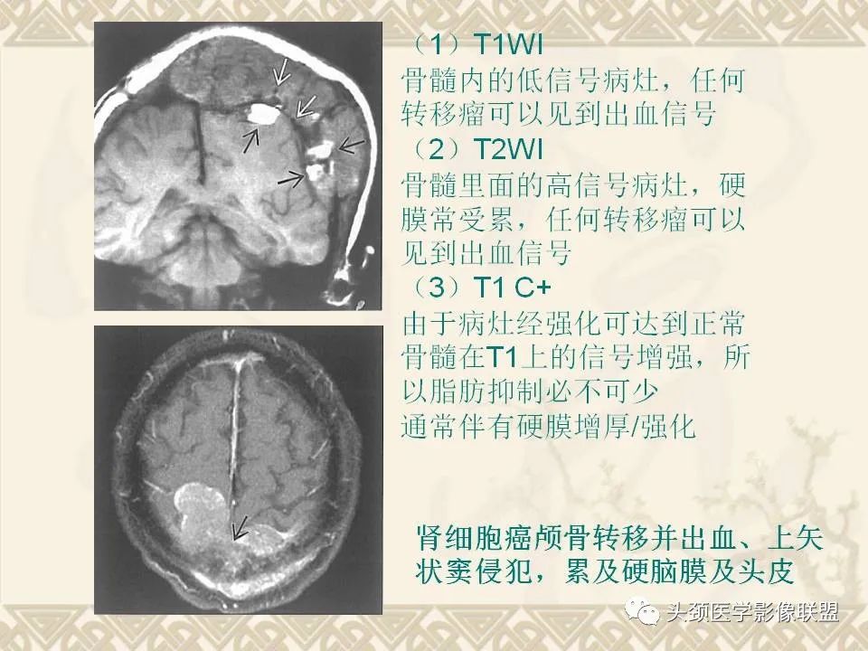 【PPT】颅骨肿瘤的影像学诊断与鉴别诊断-64