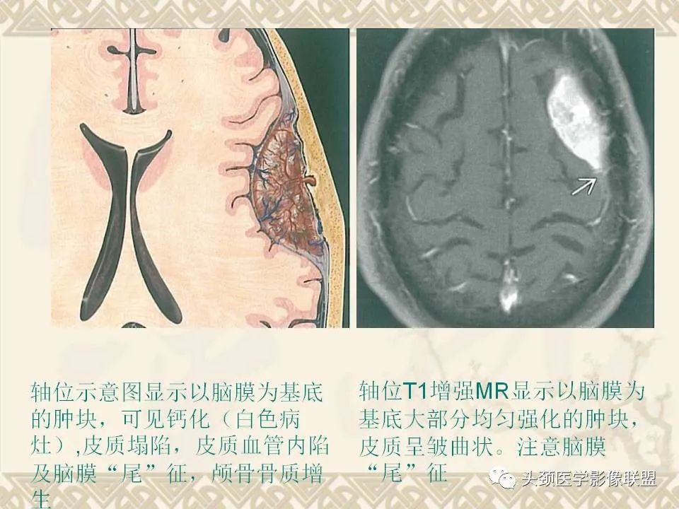 【PPT】颅骨肿瘤的影像学诊断与鉴别诊断-67