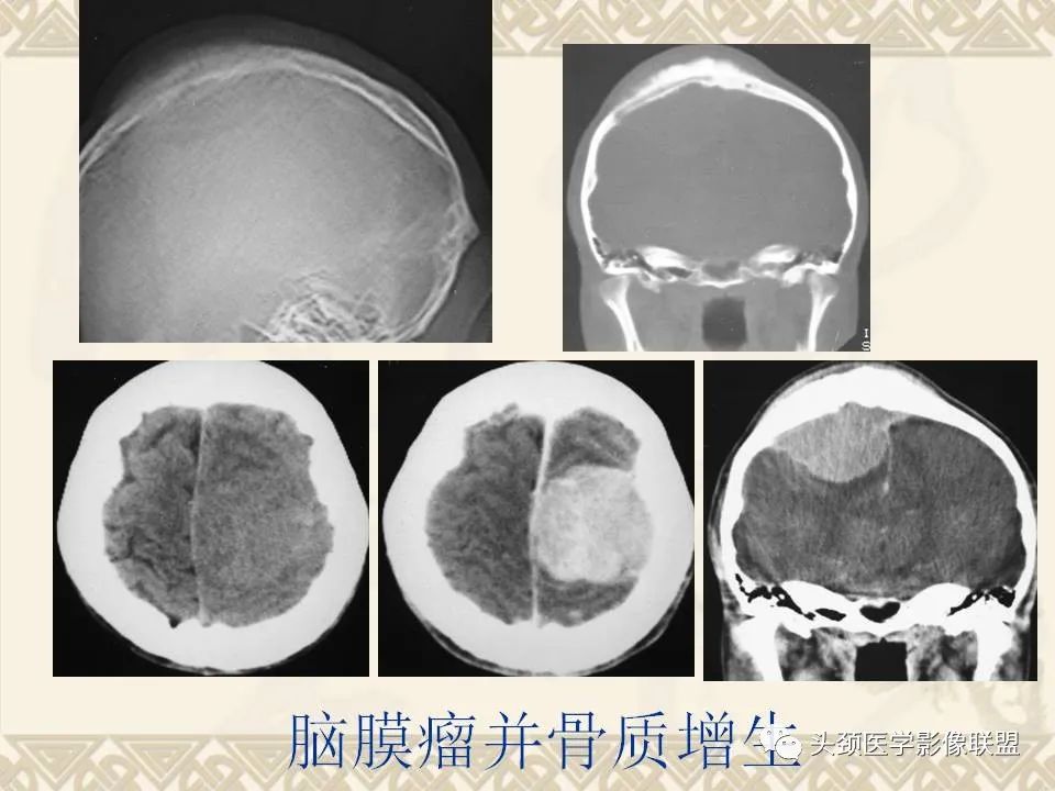 【PPT】颅骨肿瘤的影像学诊断与鉴别诊断-68