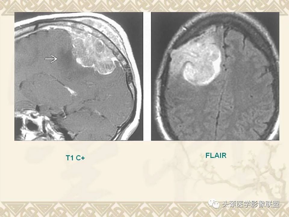【PPT】颅骨肿瘤的影像学诊断与鉴别诊断-71