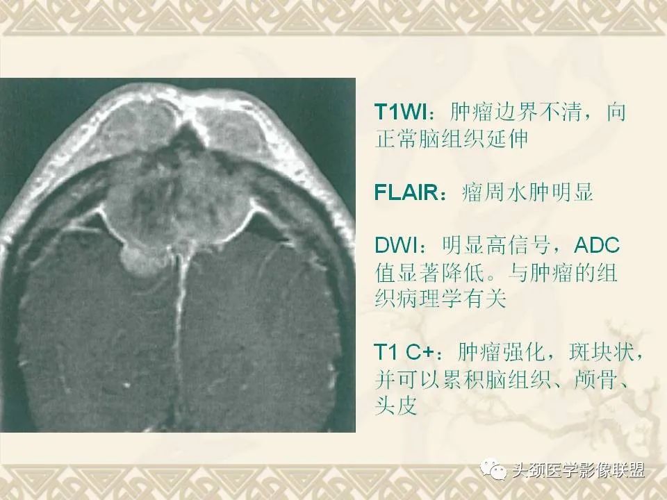 【PPT】颅骨肿瘤的影像学诊断与鉴别诊断-70