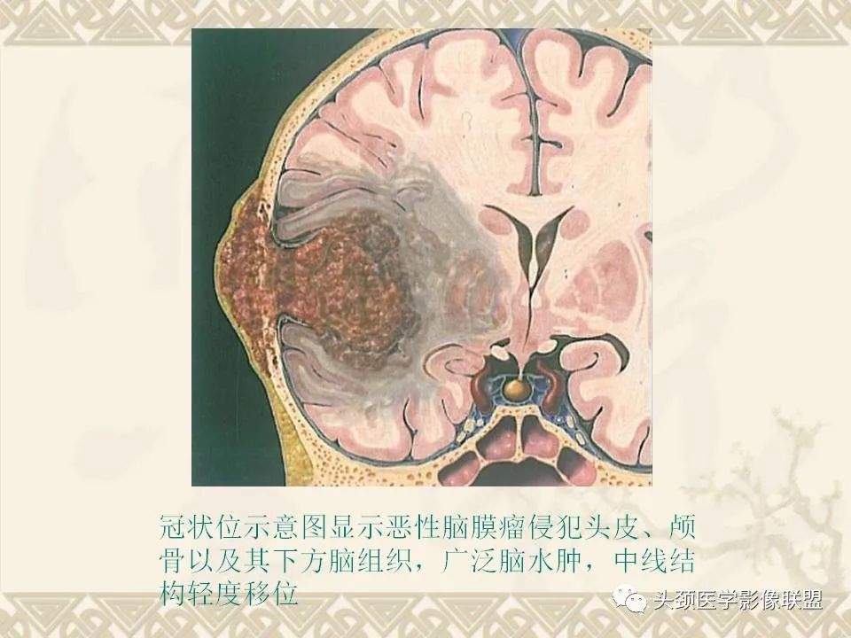 【PPT】颅骨肿瘤的影像学诊断与鉴别诊断-69