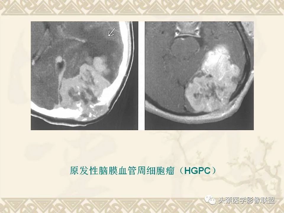 【PPT】颅骨肿瘤的影像学诊断与鉴别诊断-75