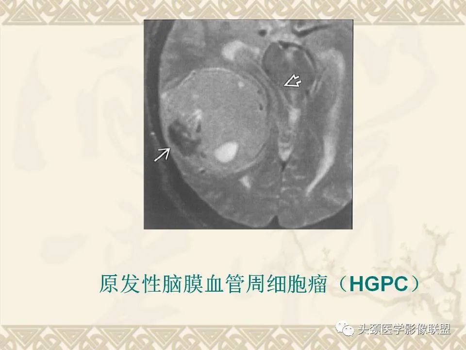 【PPT】颅骨肿瘤的影像学诊断与鉴别诊断-74