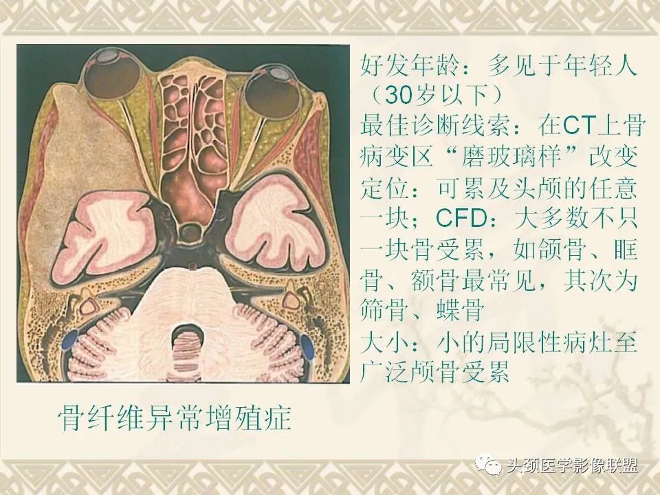 【PPT】颅骨肿瘤的影像学诊断与鉴别诊断-77