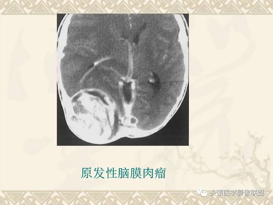 【PPT】颅骨肿瘤的影像学诊断与鉴别诊断-73