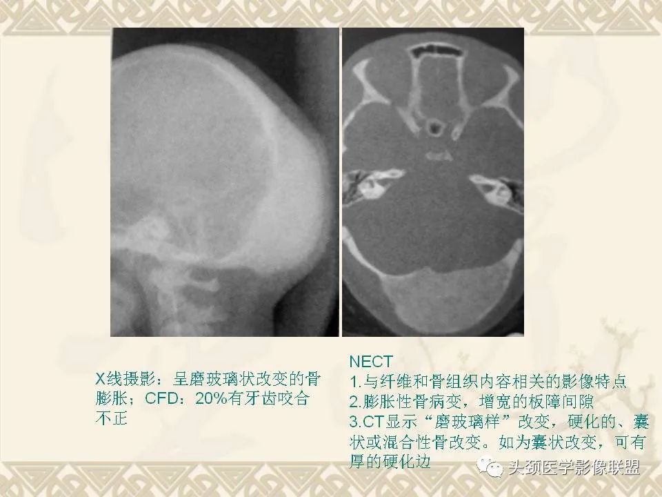 【PPT】颅骨肿瘤的影像学诊断与鉴别诊断-78