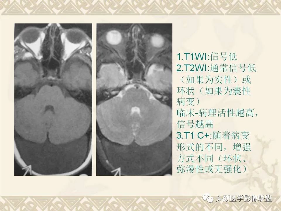 【PPT】颅骨肿瘤的影像学诊断与鉴别诊断-79