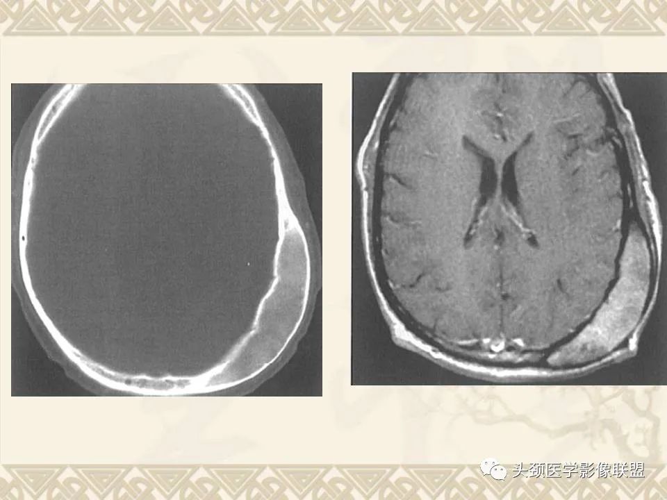 【PPT】颅骨肿瘤的影像学诊断与鉴别诊断-80