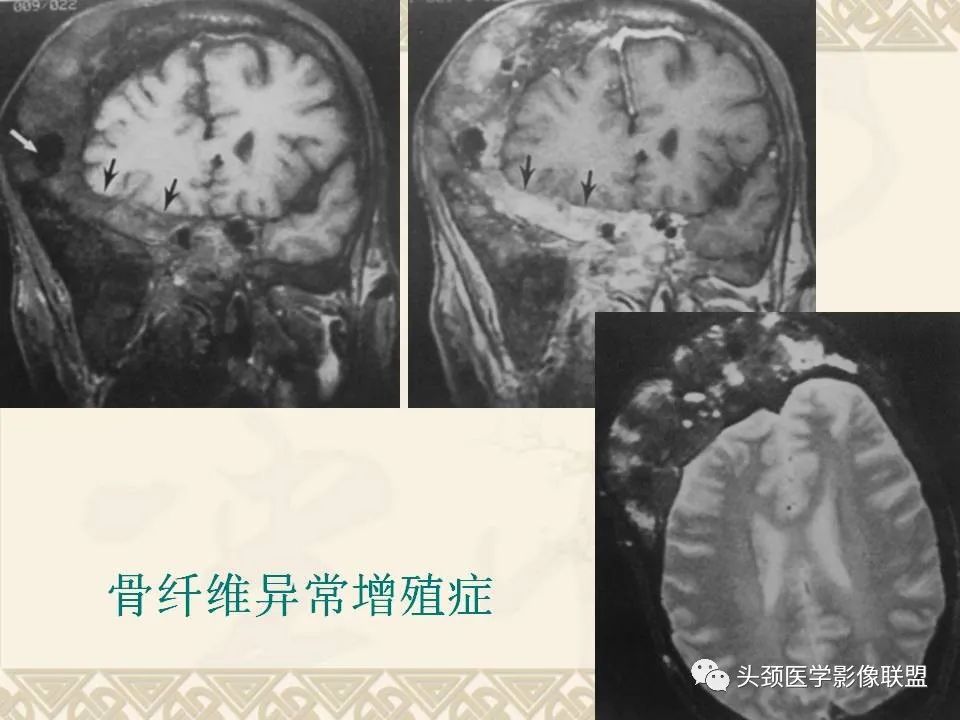 【PPT】颅骨肿瘤的影像学诊断与鉴别诊断-82