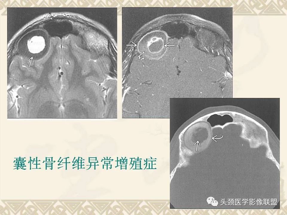 【PPT】颅骨肿瘤的影像学诊断与鉴别诊断-81