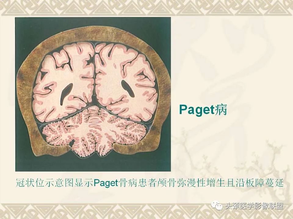 【PPT】颅骨肿瘤的影像学诊断与鉴别诊断-83