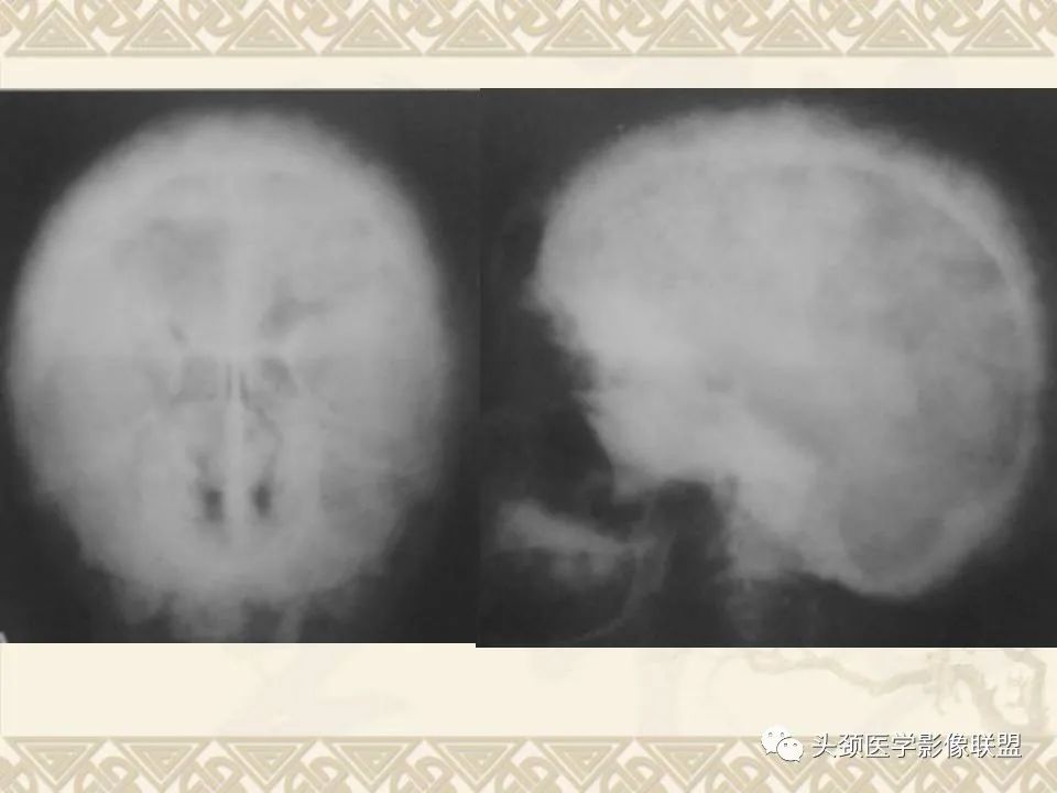 【PPT】颅骨肿瘤的影像学诊断与鉴别诊断-84
