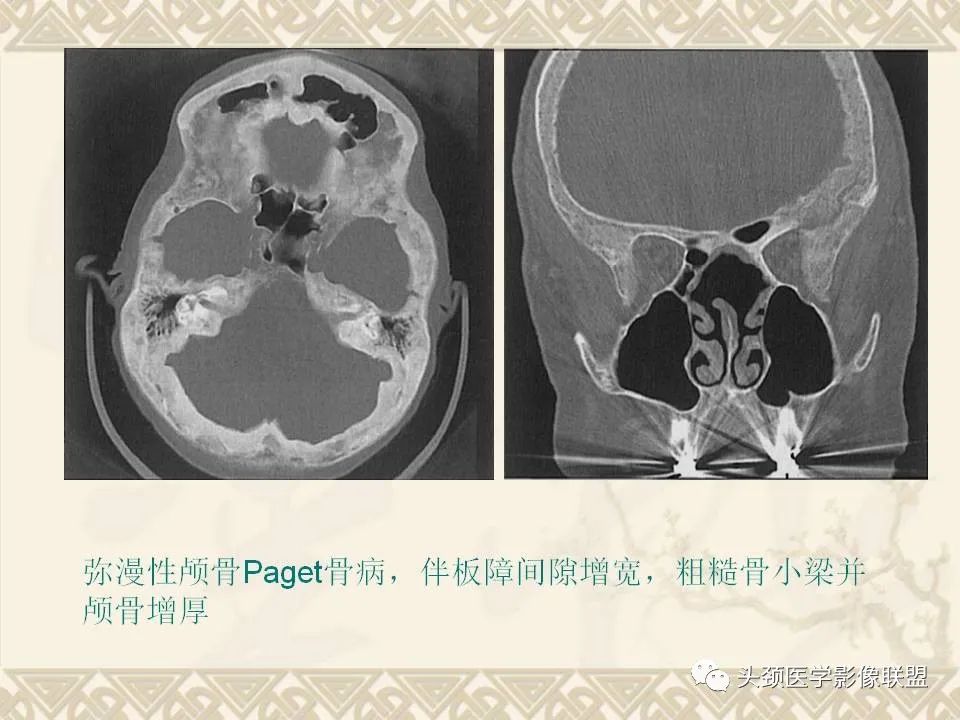 【PPT】颅骨肿瘤的影像学诊断与鉴别诊断-85