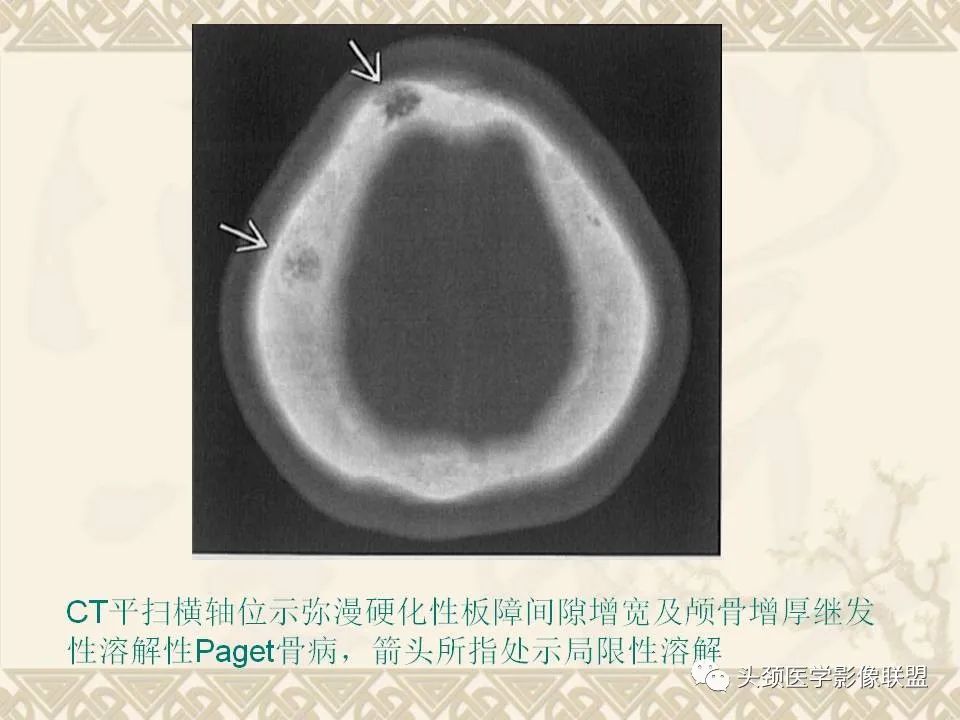 【PPT】颅骨肿瘤的影像学诊断与鉴别诊断-86