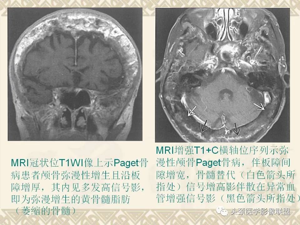 【PPT】颅骨肿瘤的影像学诊断与鉴别诊断-87