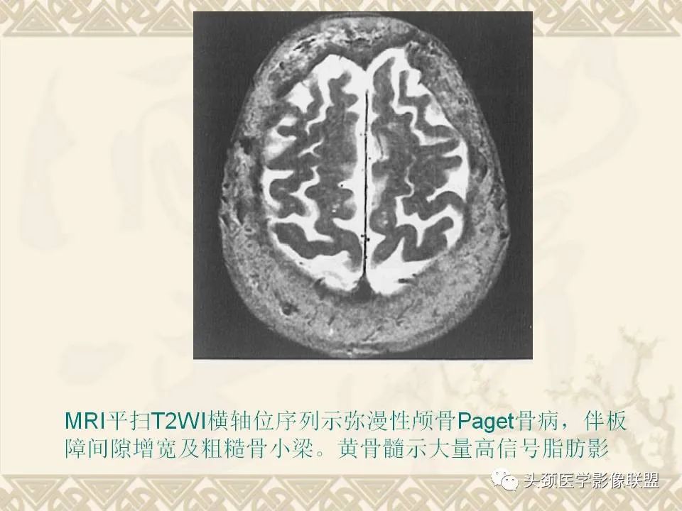 【PPT】颅骨肿瘤的影像学诊断与鉴别诊断-88