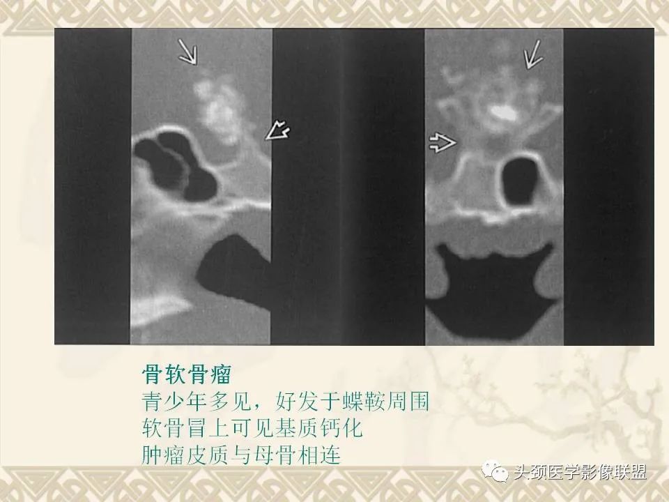 【PPT】颅骨肿瘤的影像学诊断与鉴别诊断-90