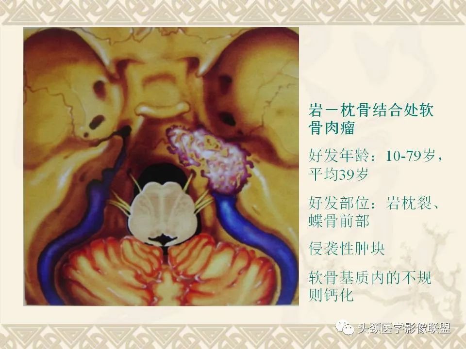 【PPT】颅骨肿瘤的影像学诊断与鉴别诊断-93