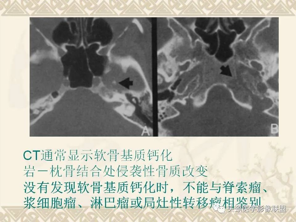 【PPT】颅骨肿瘤的影像学诊断与鉴别诊断-94