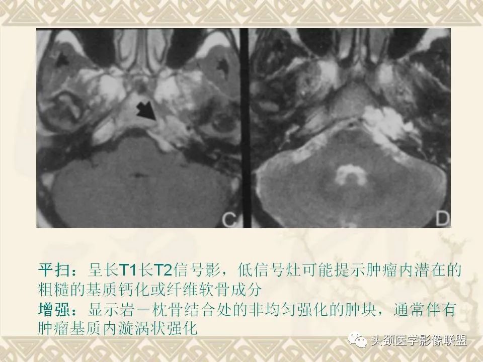 【PPT】颅骨肿瘤的影像学诊断与鉴别诊断-95