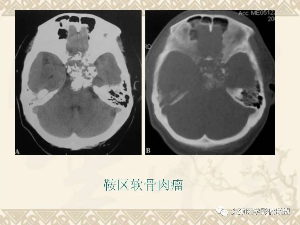 【PPT】颅骨肿瘤的影像学诊断与鉴别诊断-96