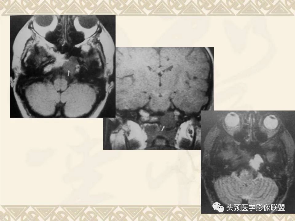 【PPT】颅骨肿瘤的影像学诊断与鉴别诊断-97