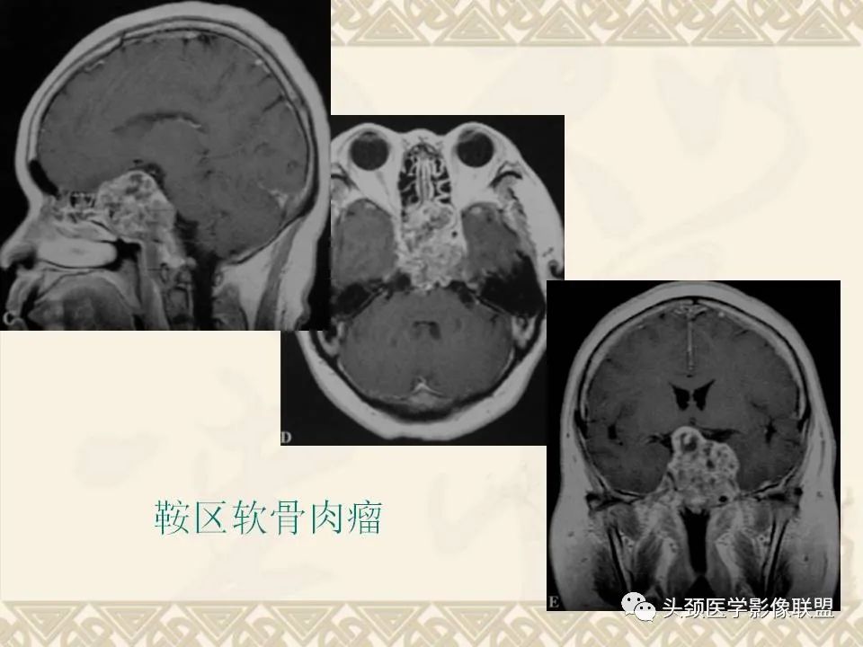 【PPT】颅骨肿瘤的影像学诊断与鉴别诊断-98