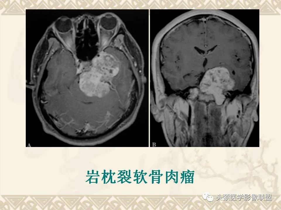 【PPT】颅骨肿瘤的影像学诊断与鉴别诊断-99