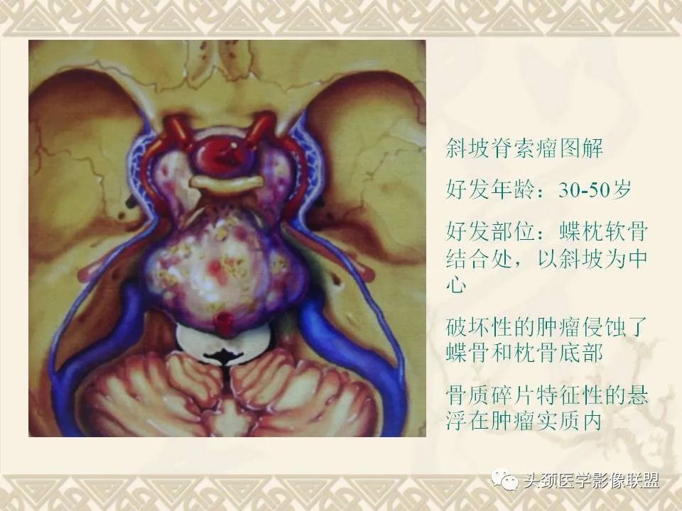 【PPT】颅骨肿瘤的影像学诊断与鉴别诊断-100