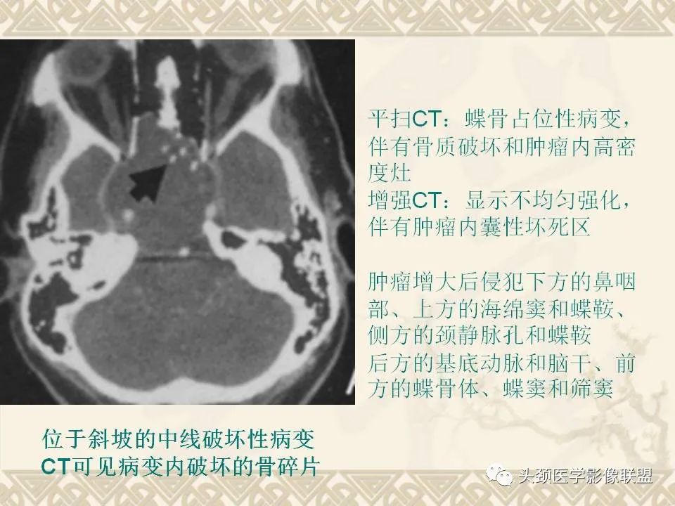 【PPT】颅骨肿瘤的影像学诊断与鉴别诊断-101
