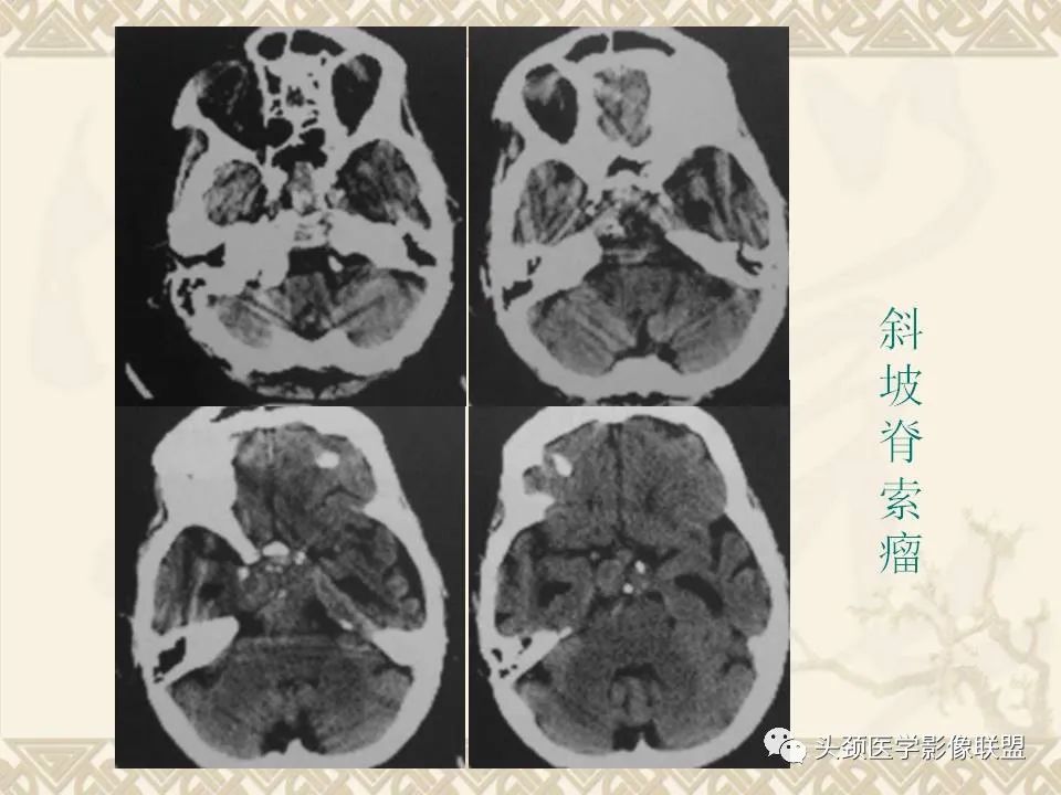 【PPT】颅骨肿瘤的影像学诊断与鉴别诊断-102