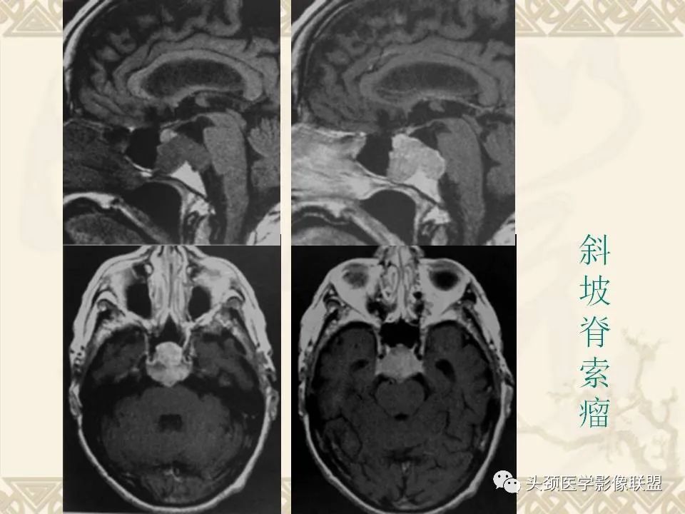 【PPT】颅骨肿瘤的影像学诊断与鉴别诊断-103