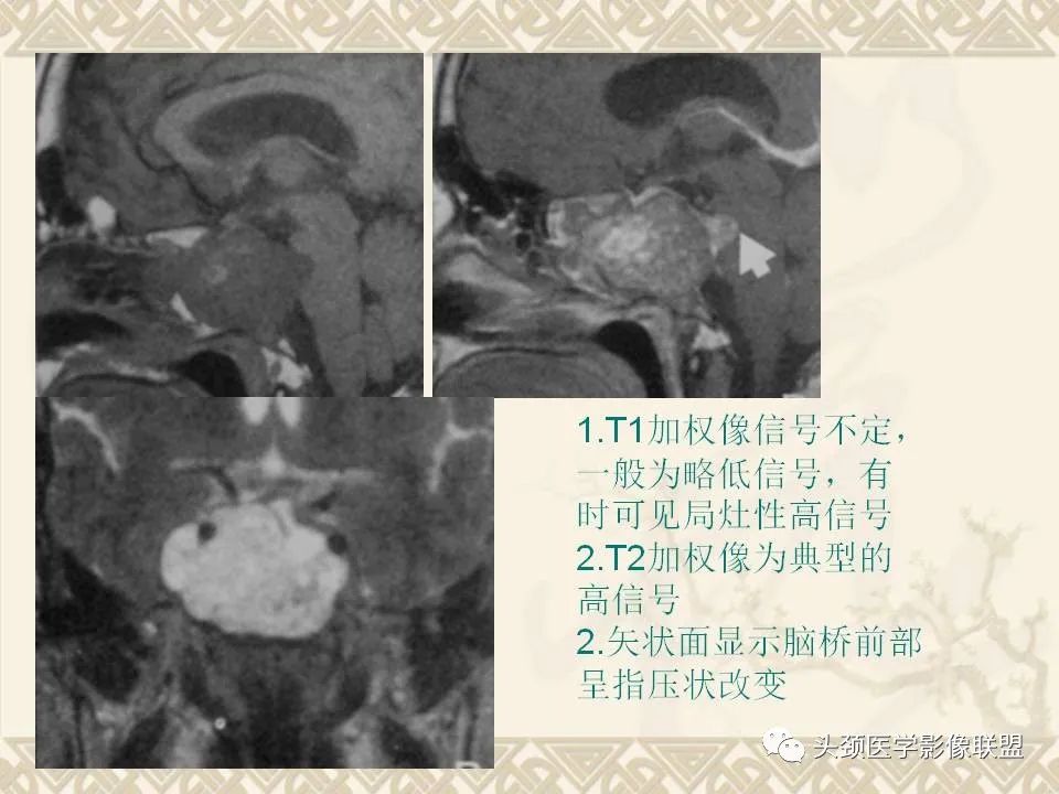 【PPT】颅骨肿瘤的影像学诊断与鉴别诊断-104